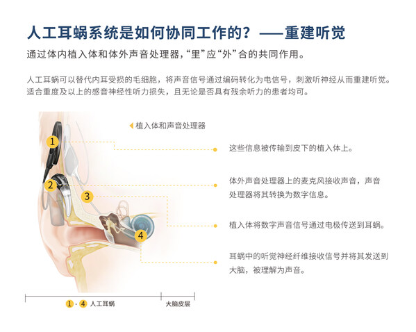 人工耳蜗的工作原理