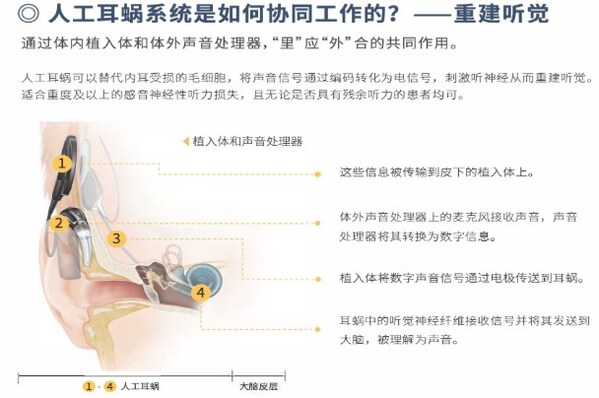 人工耳蜗工作原理 人工耳蜗工作原理